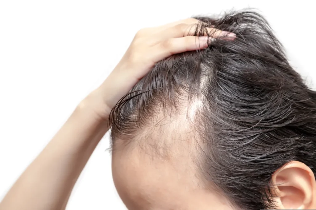 Alopecia