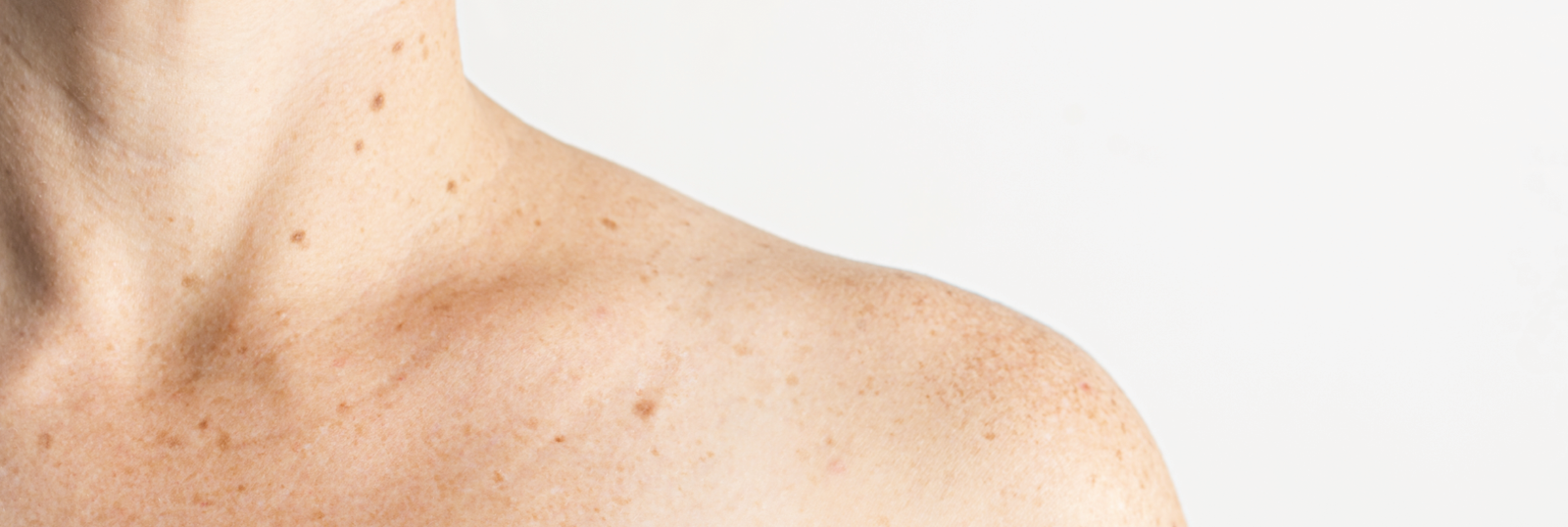 Brown spots