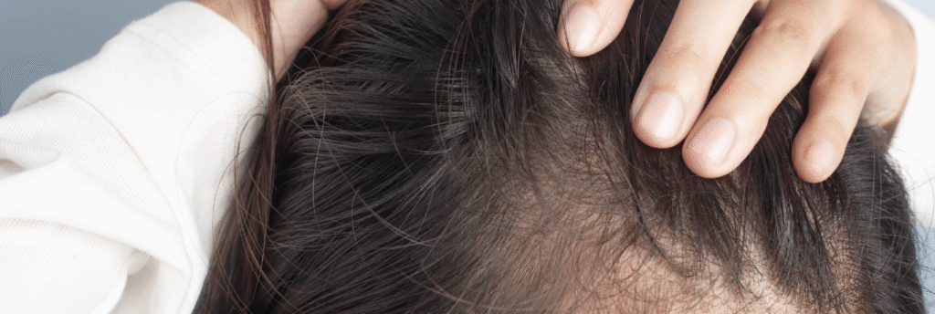 Frontal Fibrosing Alopecia
