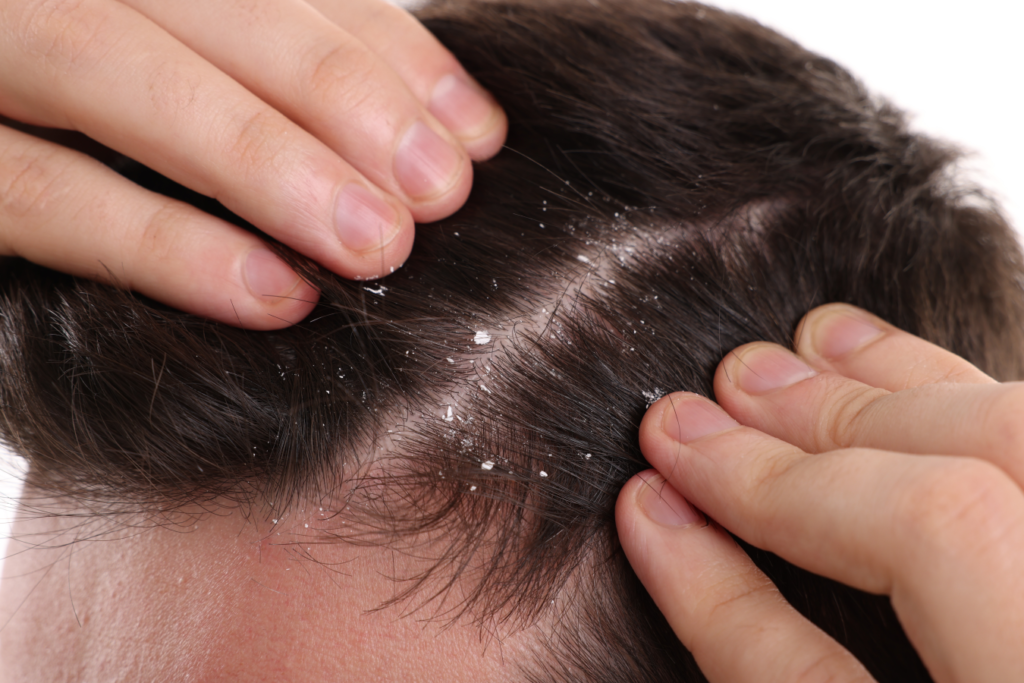 dandruff