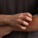 Stop Scratching! Here Are 5 Effective Ways to Minimize the Itching of Atopic Dermatitis
