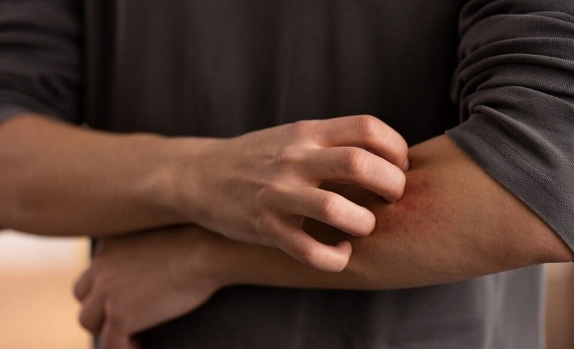 Atopic Dermatitis