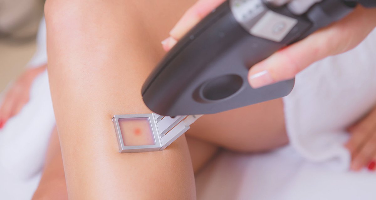 Laser hair removal