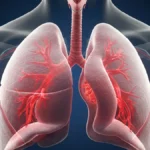 Bilateral Pneumonia: What It Is, Symptoms, And How To Prevent This Serious Lung Infection