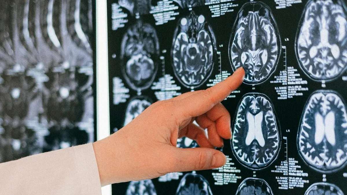 Brain aneurysm