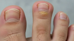 Green nail syndrome