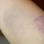 Frequent Bruising And Bleeding: Possible Signs Of Promyelocytic Leukemia