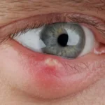 How To Cure A Stye Quickly?