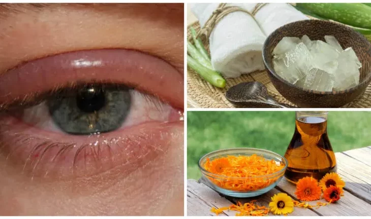 Fight Eye Infections With These Remedies