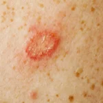 Natural Remedies To Treat Skin Fungus