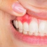 6 Remedies To Combat Swollen Gums