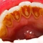 How To Remove And Prevent Tartar From Teeth