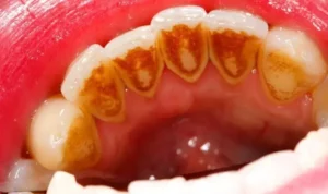 How To Remove And Prevent Tartar From Teeth